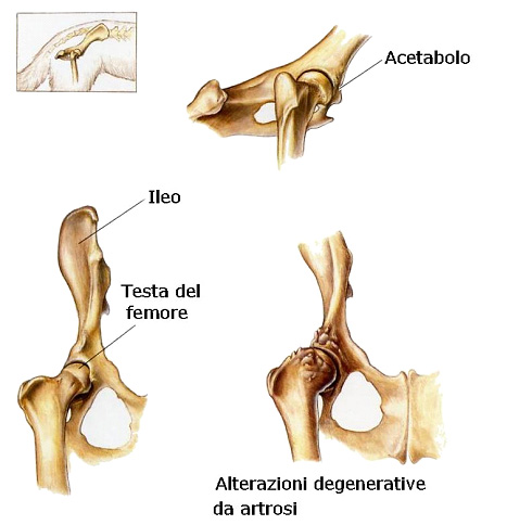 articolazione articolazione displasia dell'anca
